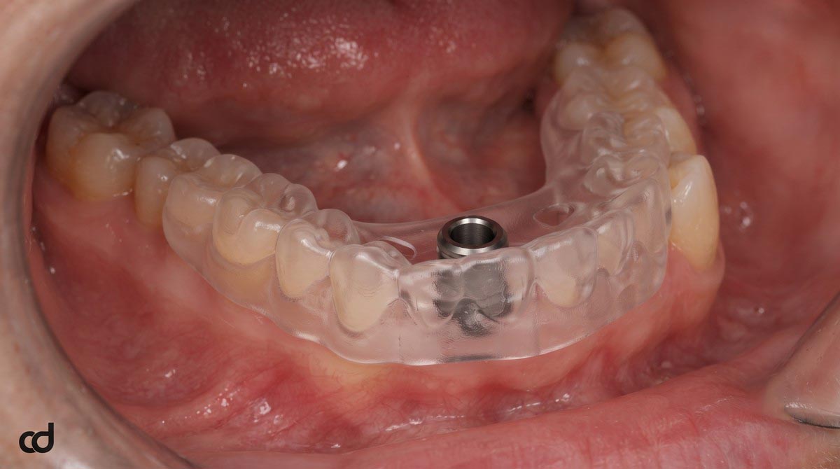High-resolution intraoral photograph displaying a bounded single-tooth edentulous site in the posterior mandible. The Curedent surgical guide is trial-seated on adjacent dentition, demonstrating intimate adaptation, seated inspection windows, and unobstructed access to the site